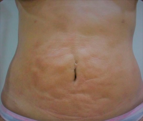 Seromas E Fibroases P S Lipoaspira O Melhores Tratamentos