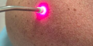Conhecimentos básicos em laserterapia – parte 2